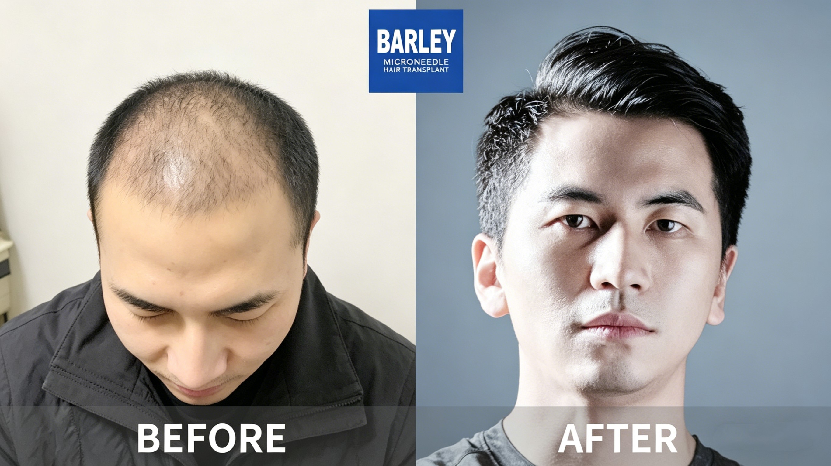 Hair Density