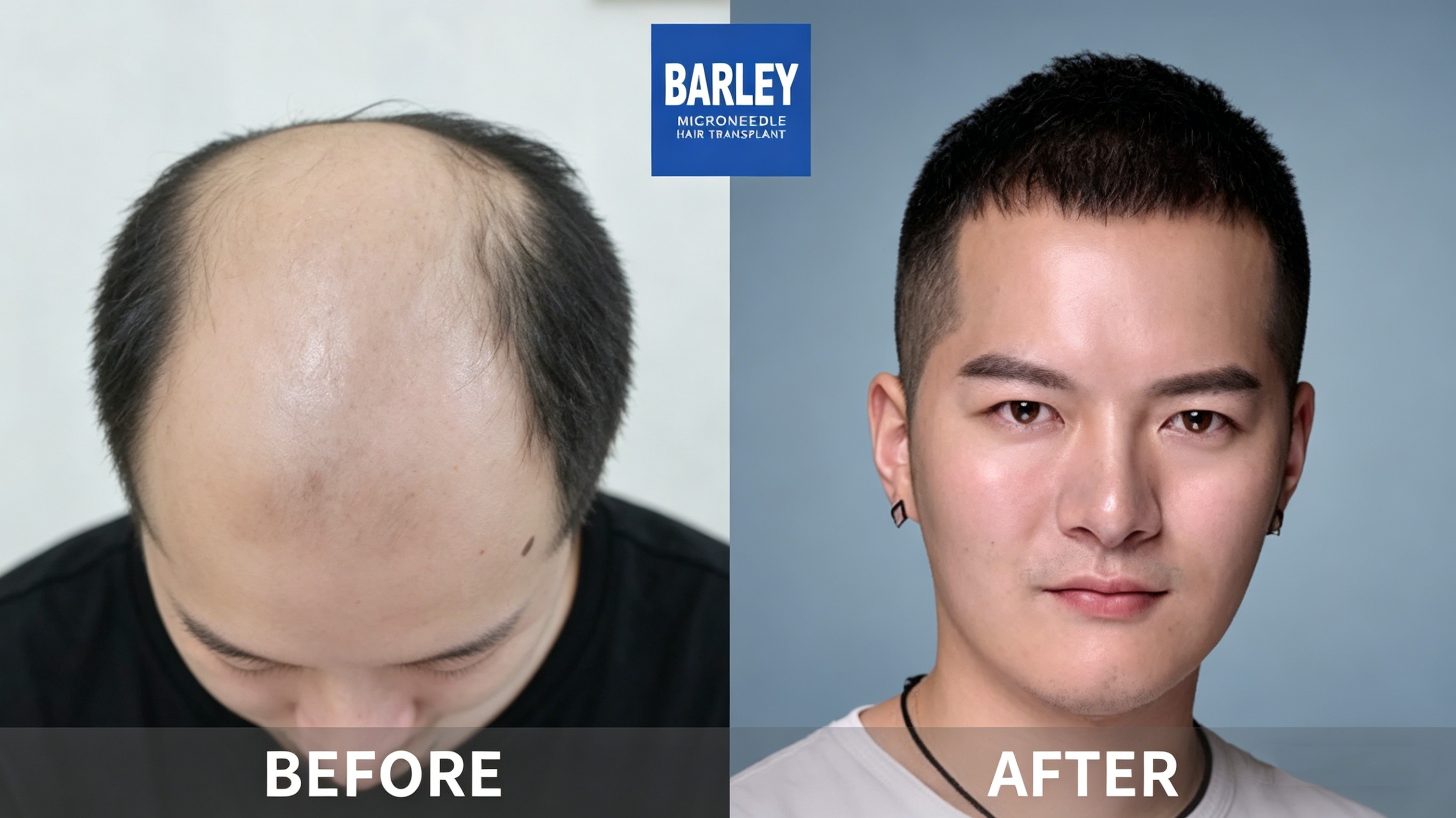Barley Hair Transplant Hospital China - Premier Hair Restoration Clinic