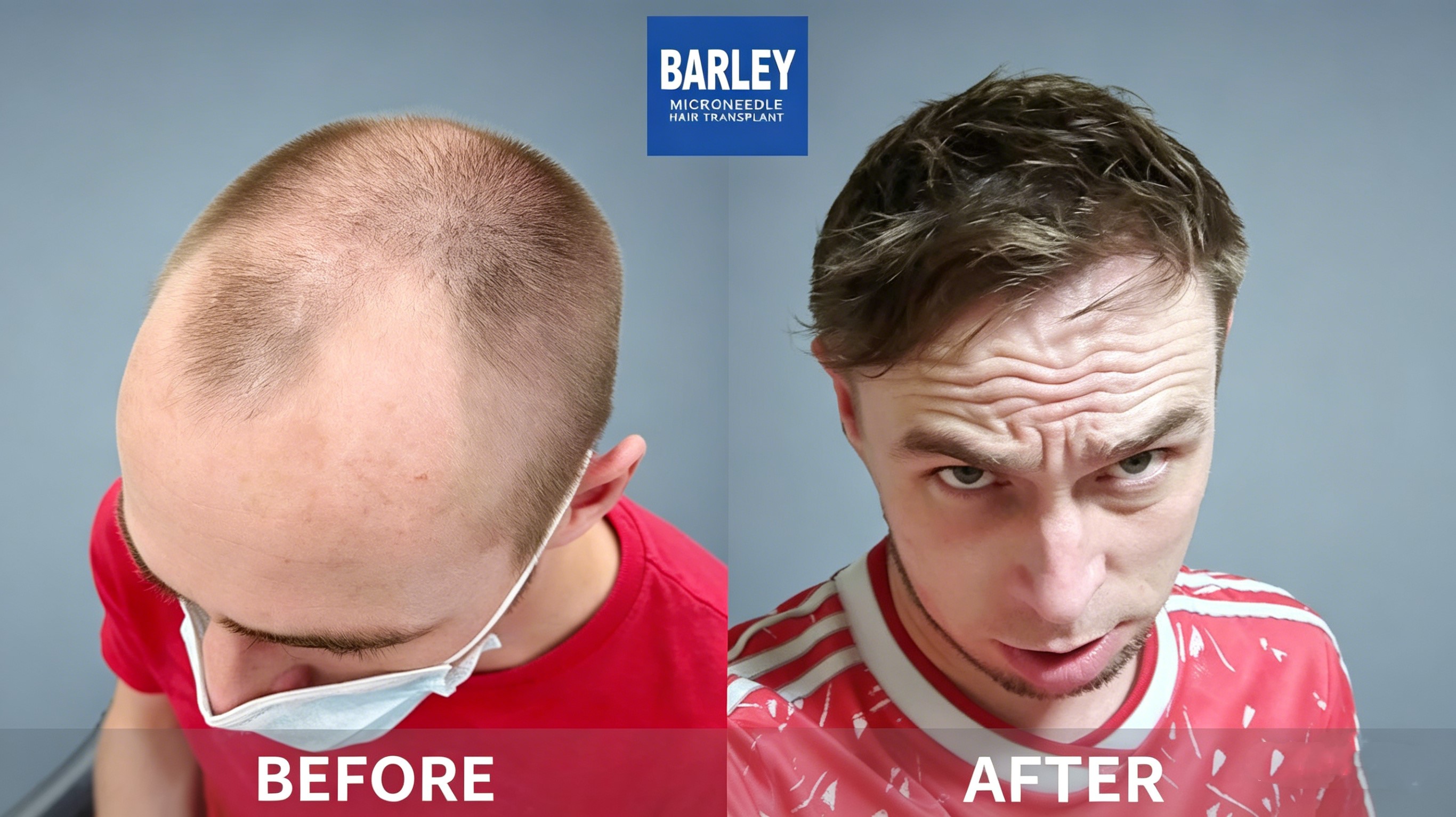 Barley Hair Transplant Technology