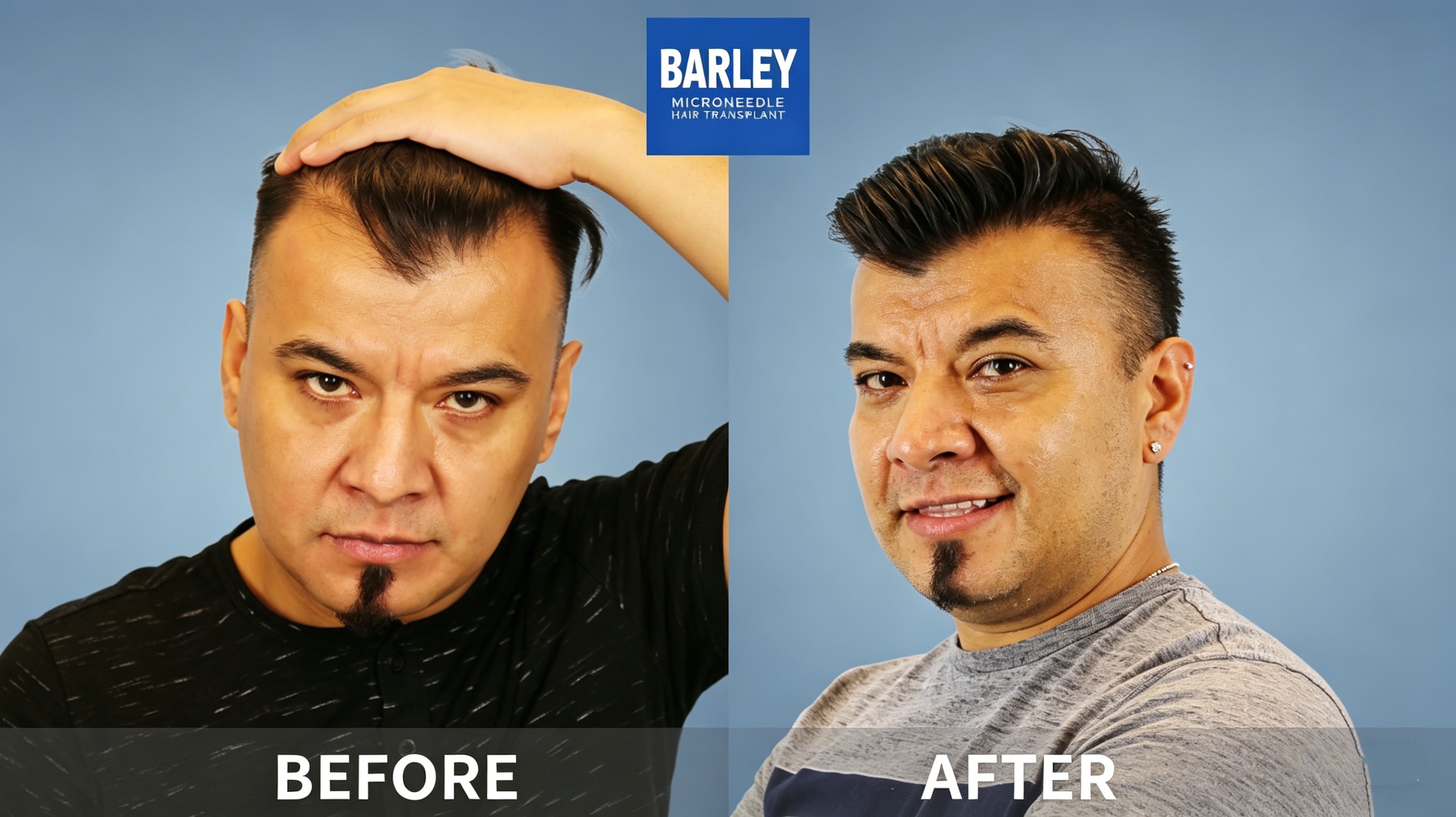Hair transplant journey - International patients welcome at Barley China