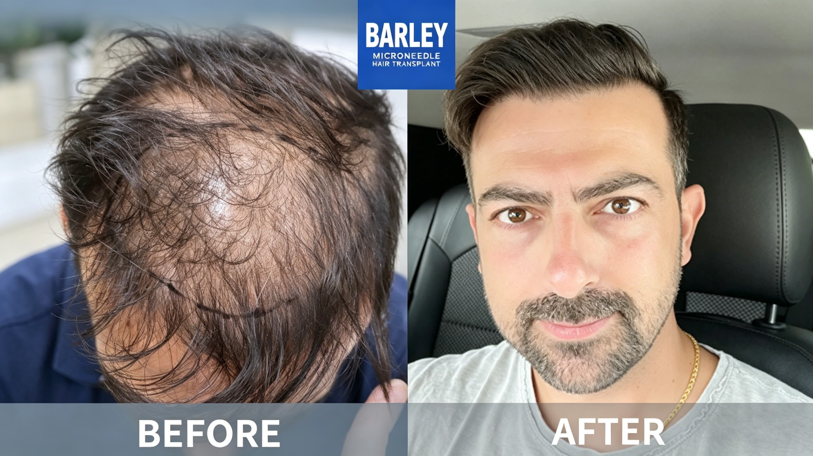 Body Hair Enhancement