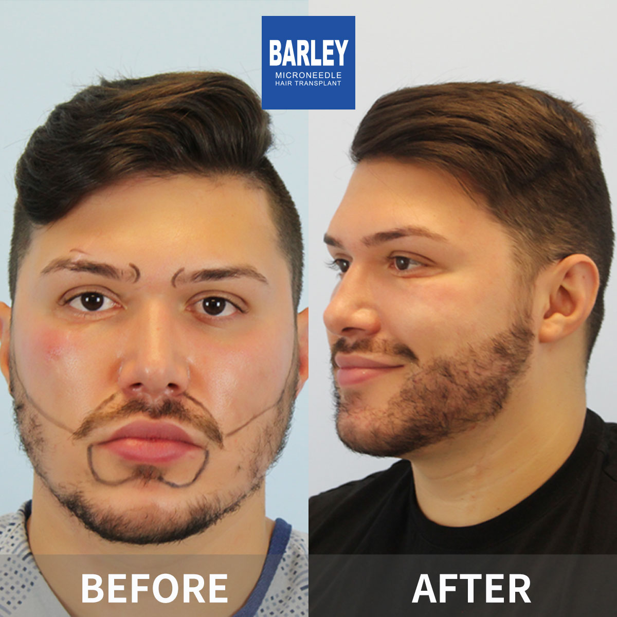 Beard