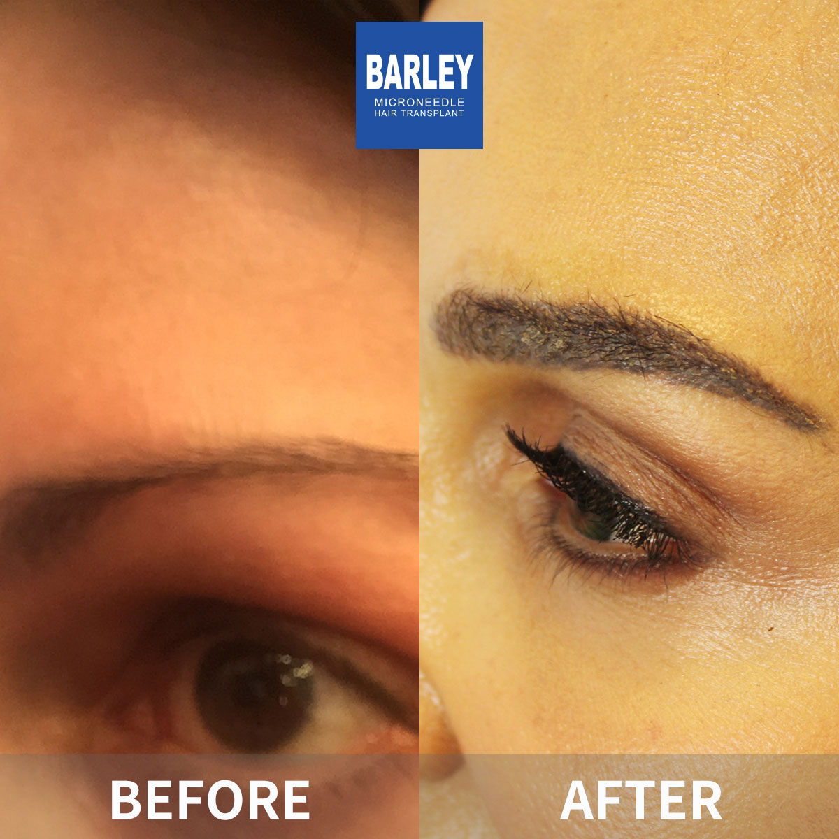 Eyebrow transplant results