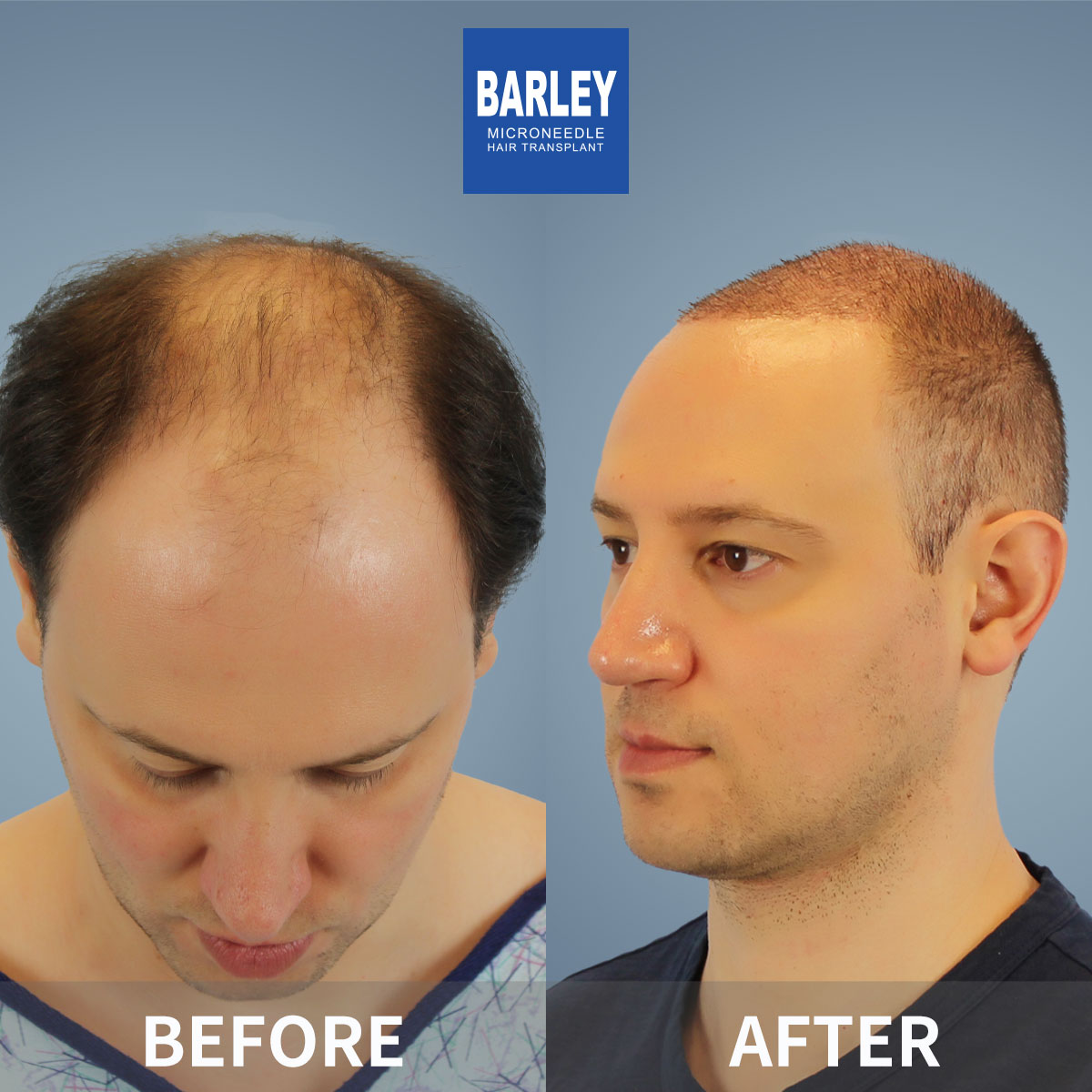 FUT Hair Transplant