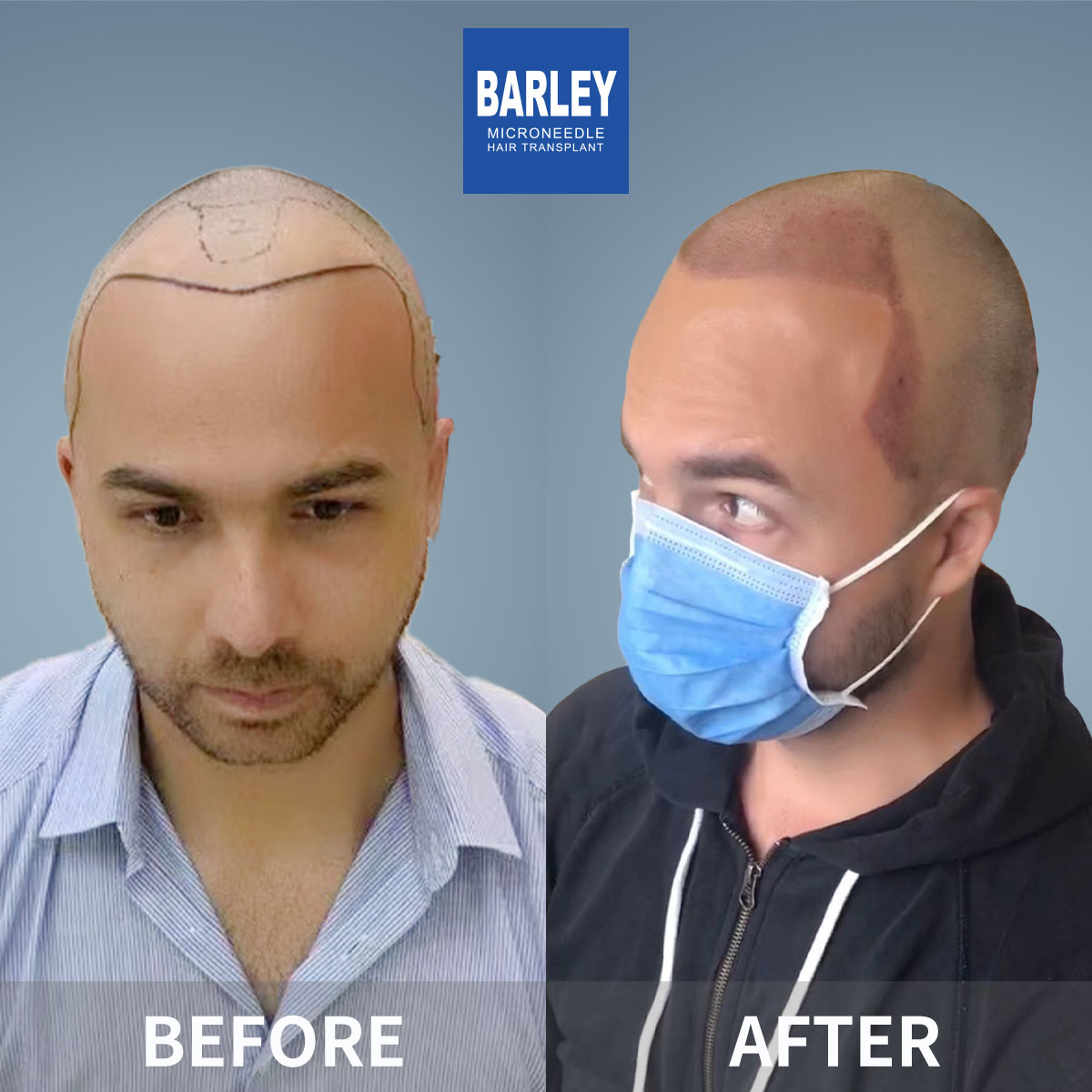 FUT Female Hair Restoration Results