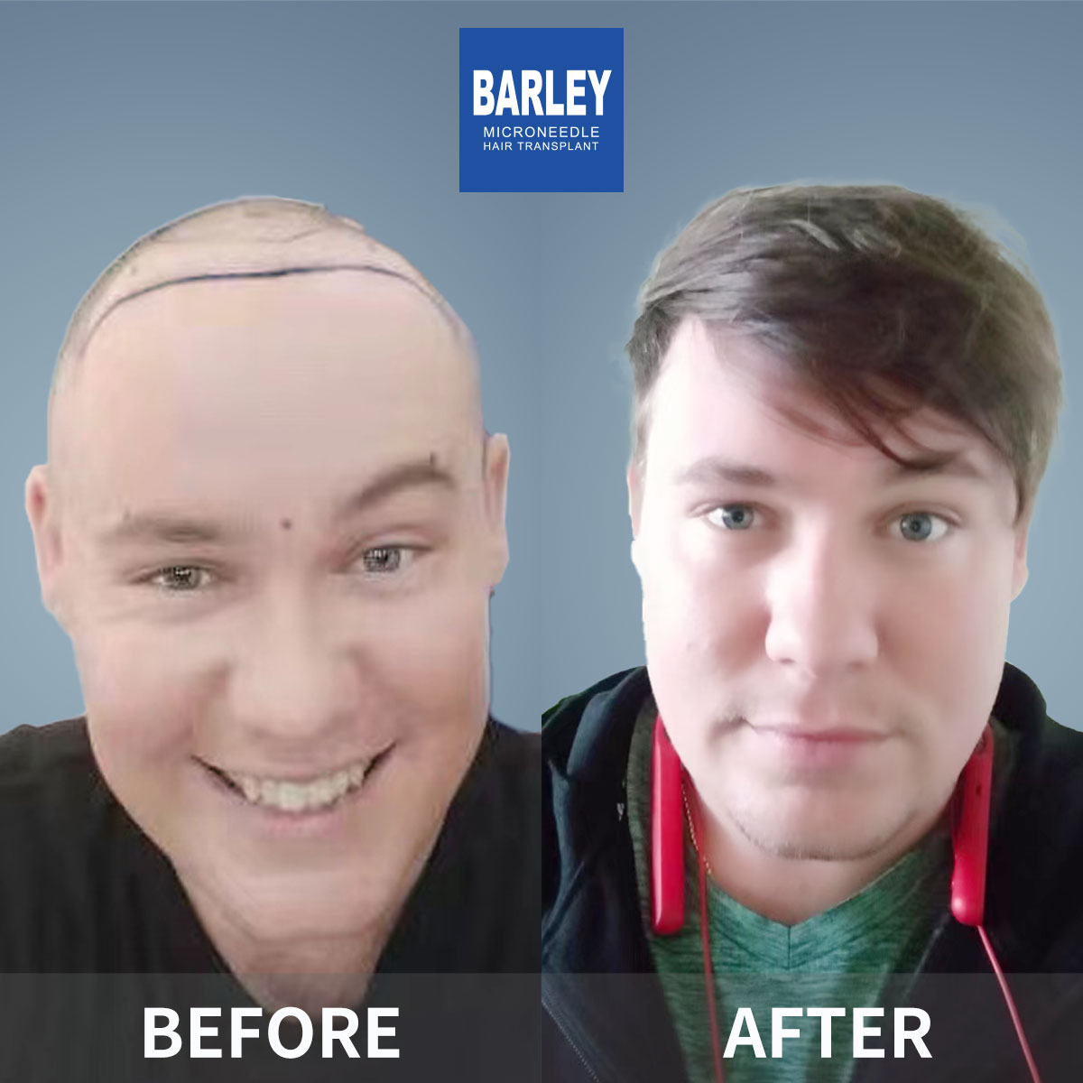 Finasteride Results