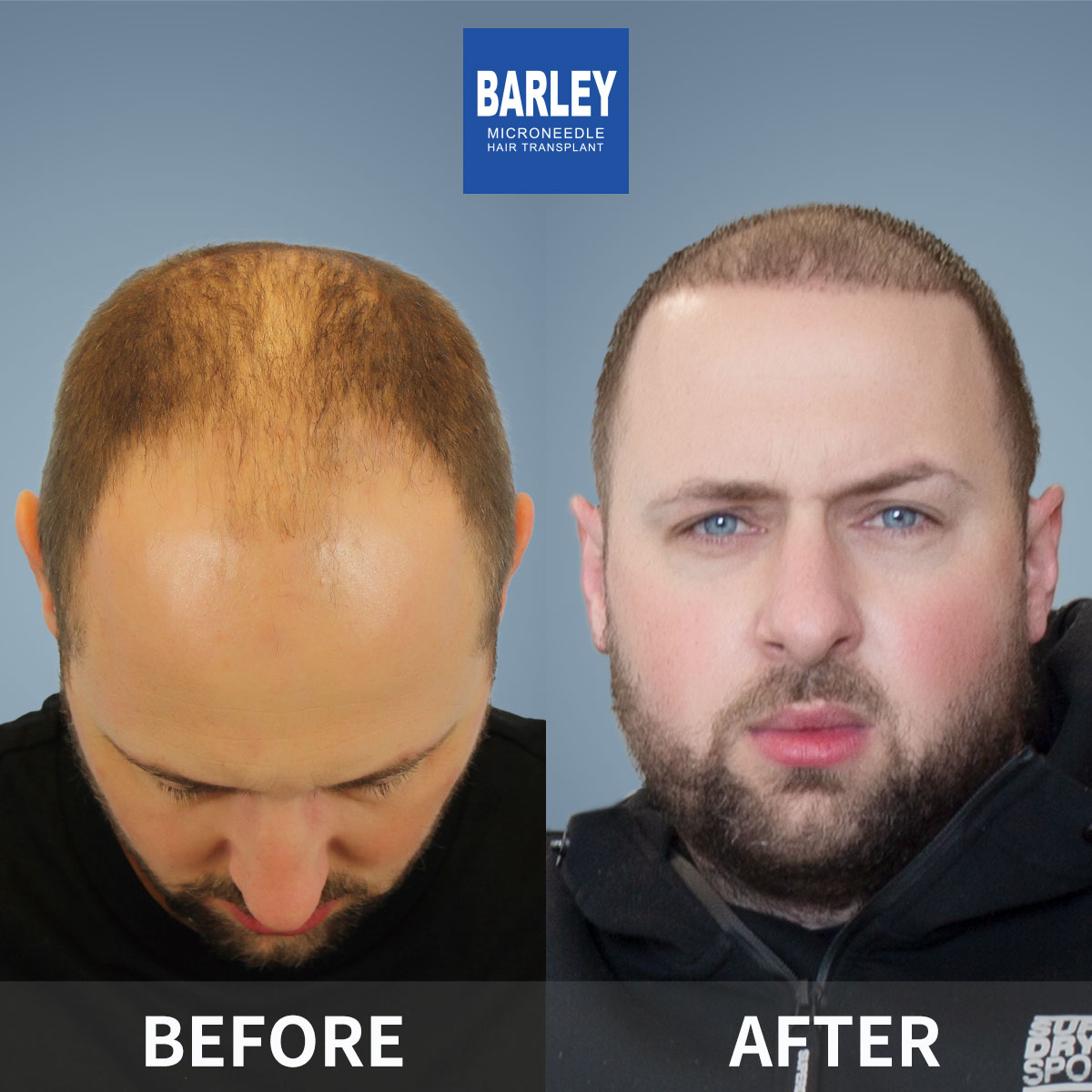 Finasteride