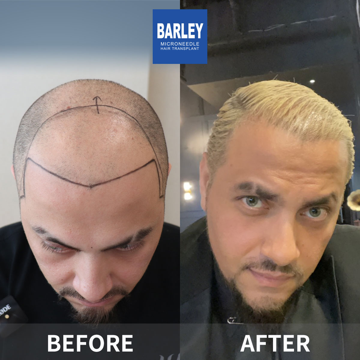 FUT Eyebrow Transplant Results