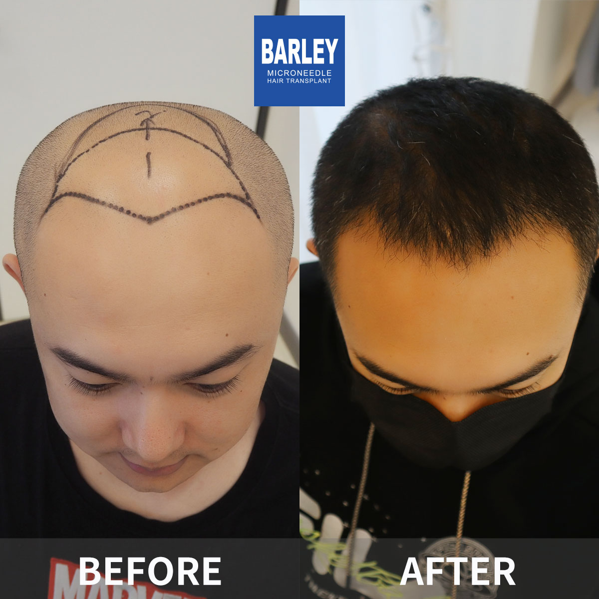 Male baldness restoration before and after