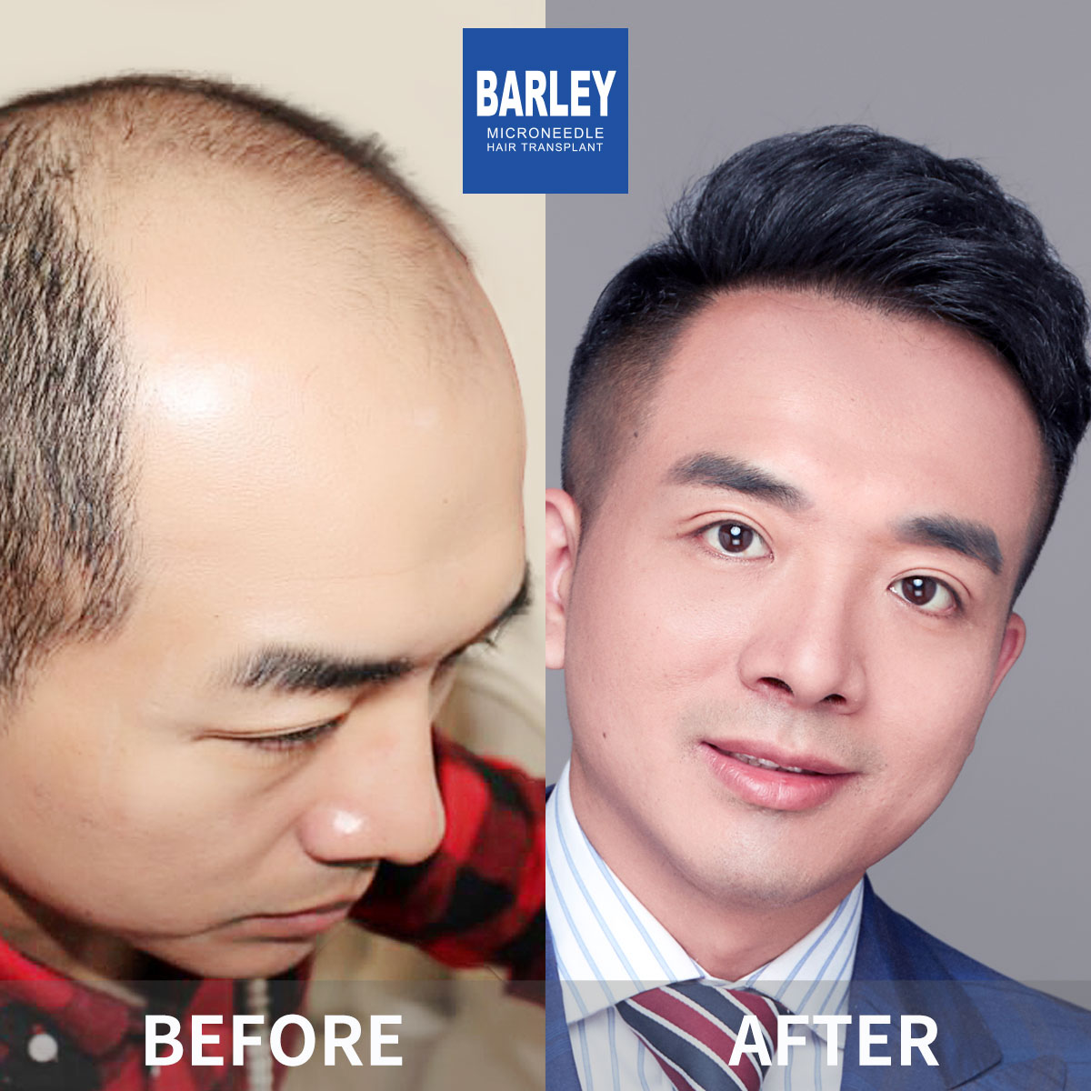 Baldness Treatment
