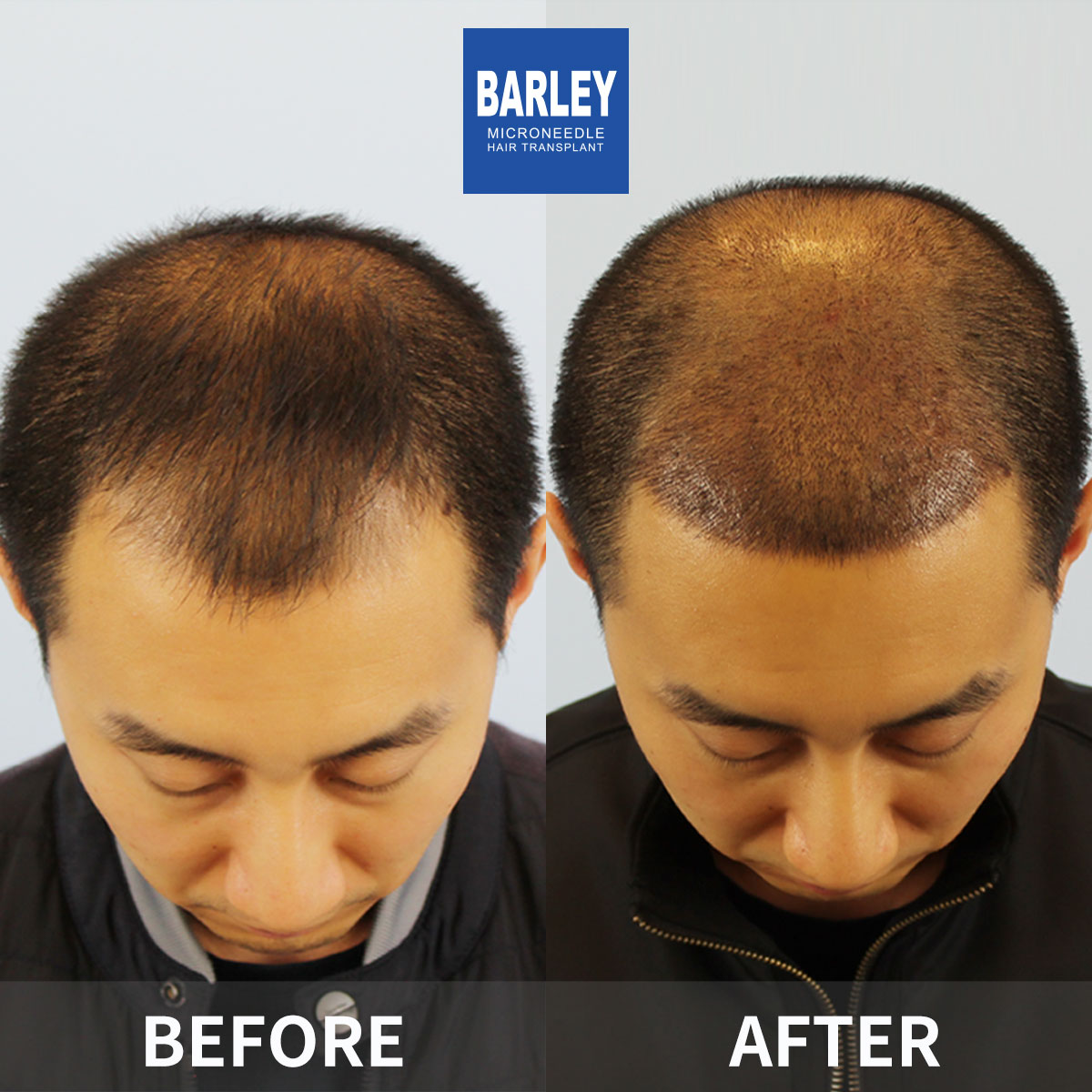 Male Baldness