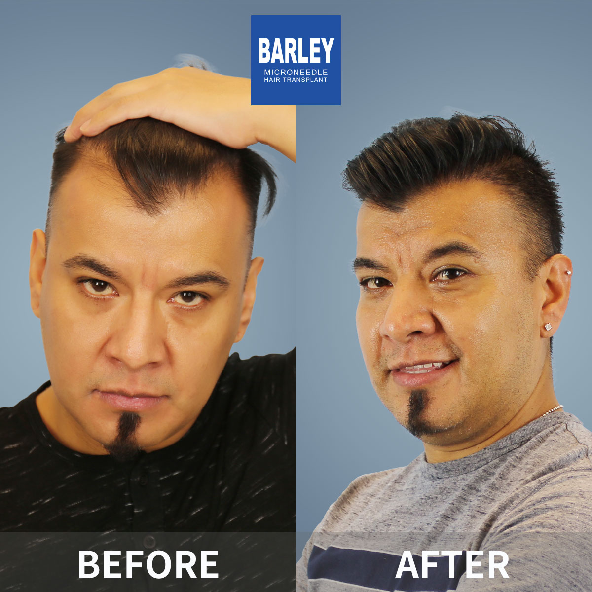 Minoxidil