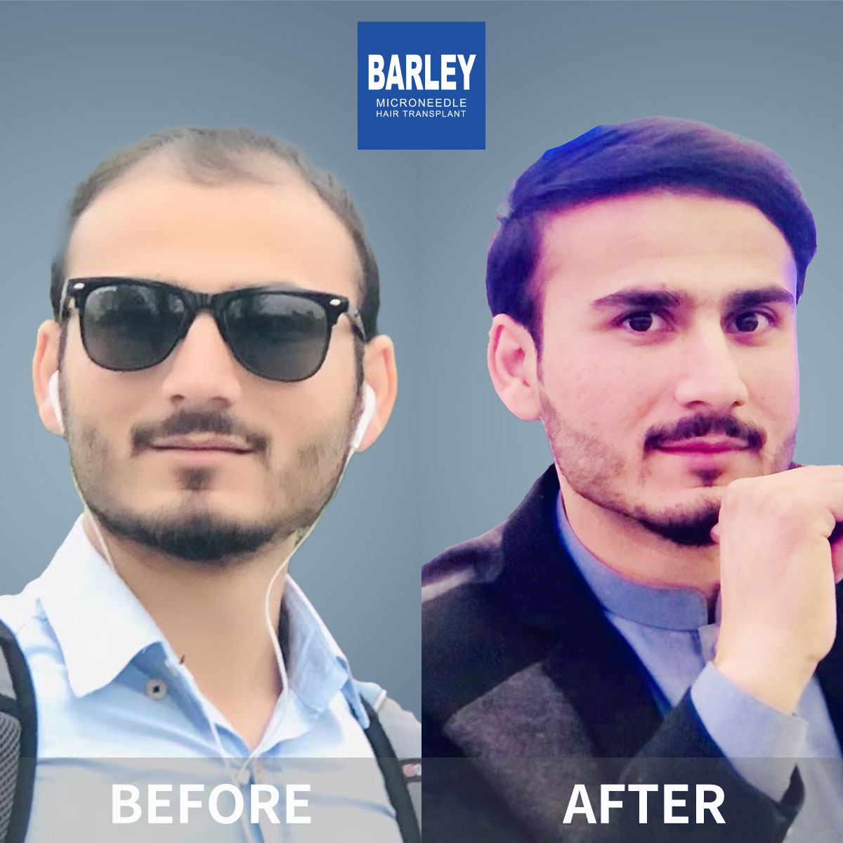 Male Hairline