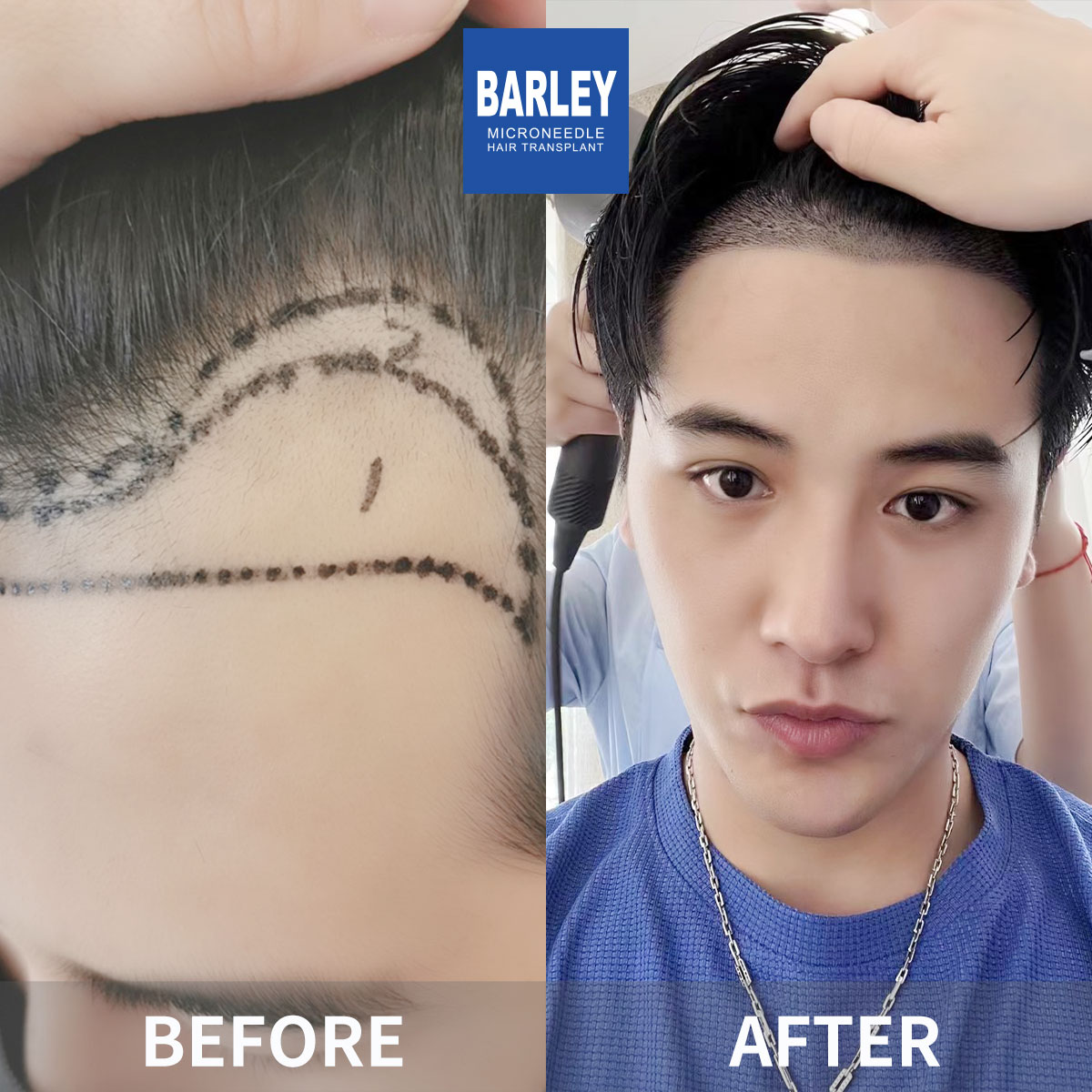 Diffuse Thinning Treatment