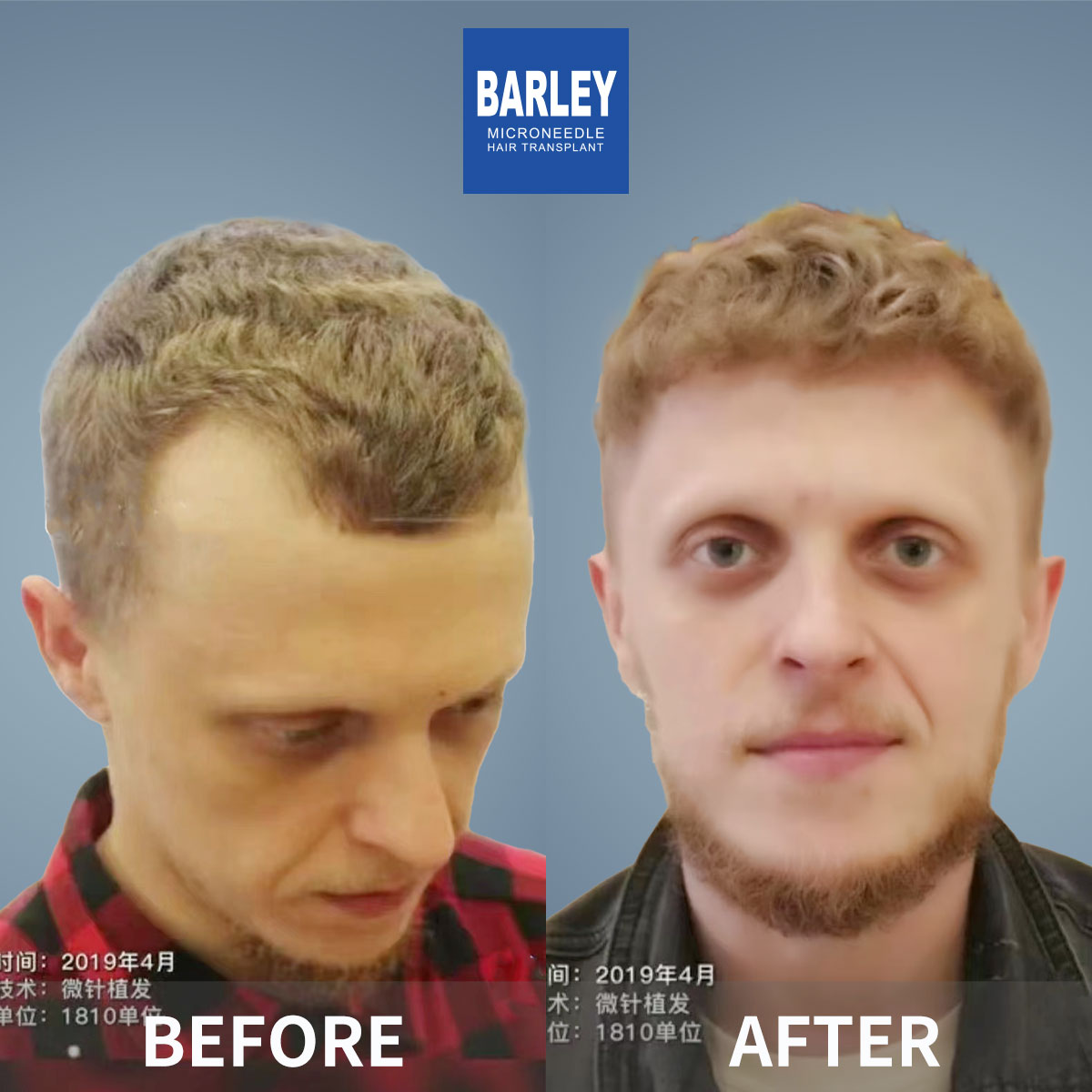 FUT Advanced Baldness Results