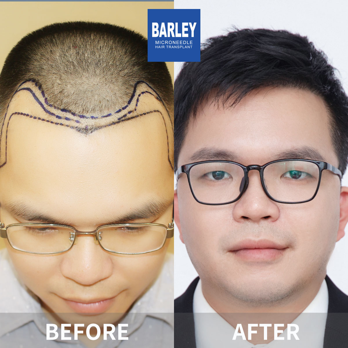 Minoxidil Regrowth