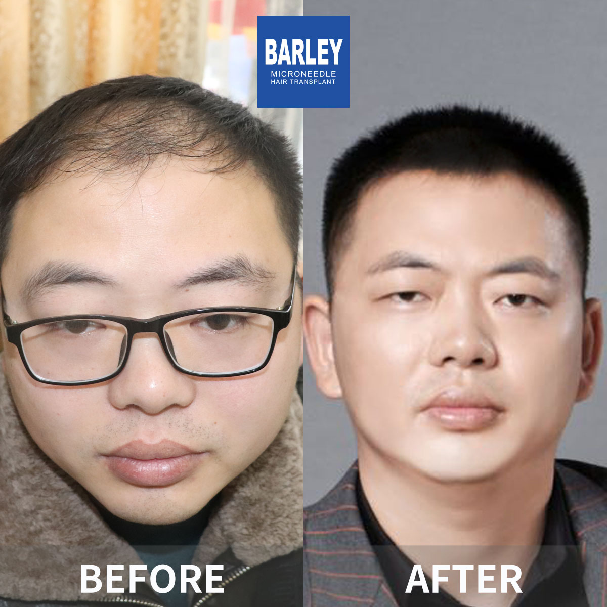 Hairline Restoration