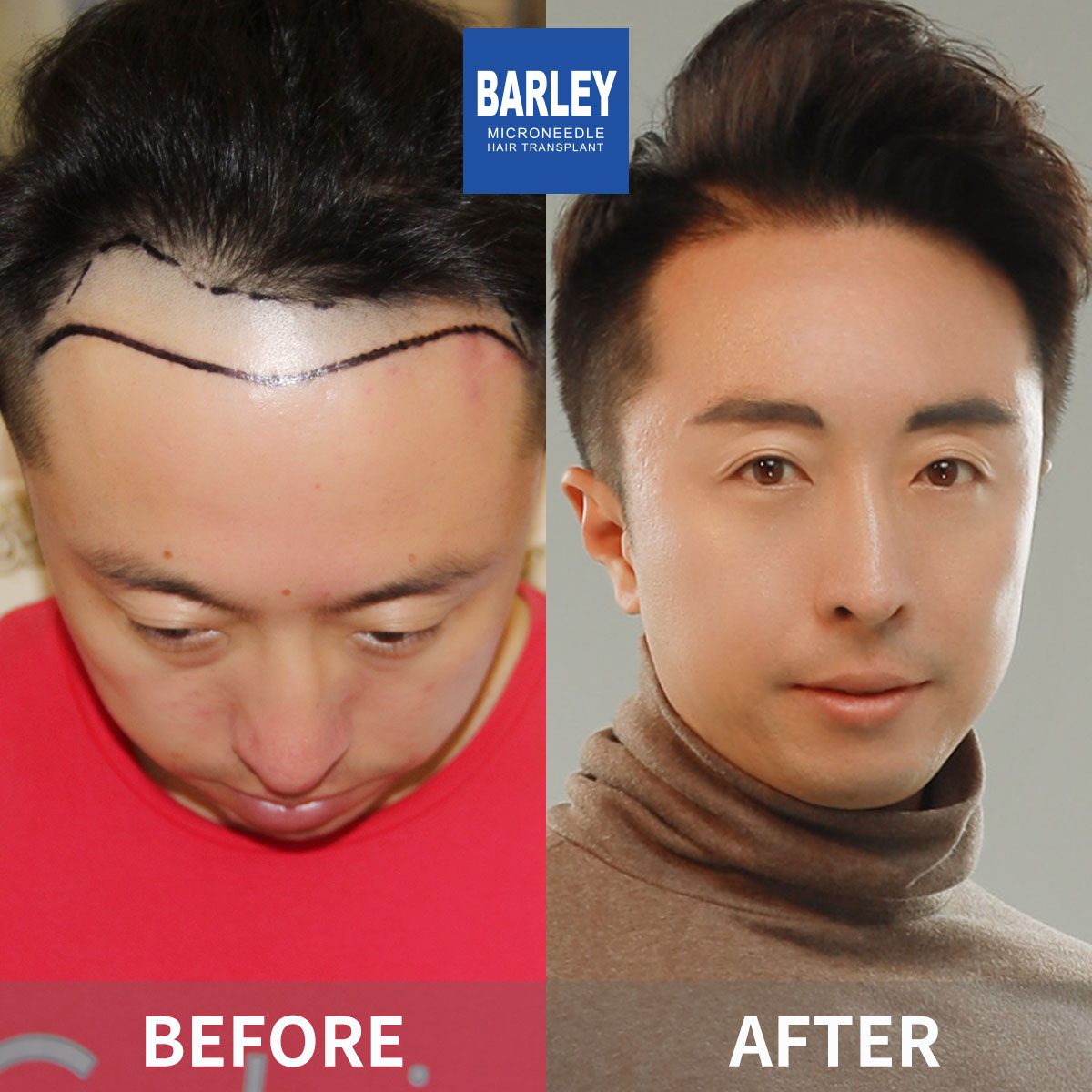 Male Hairline