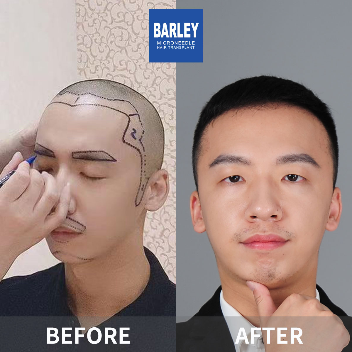 Male Hairline