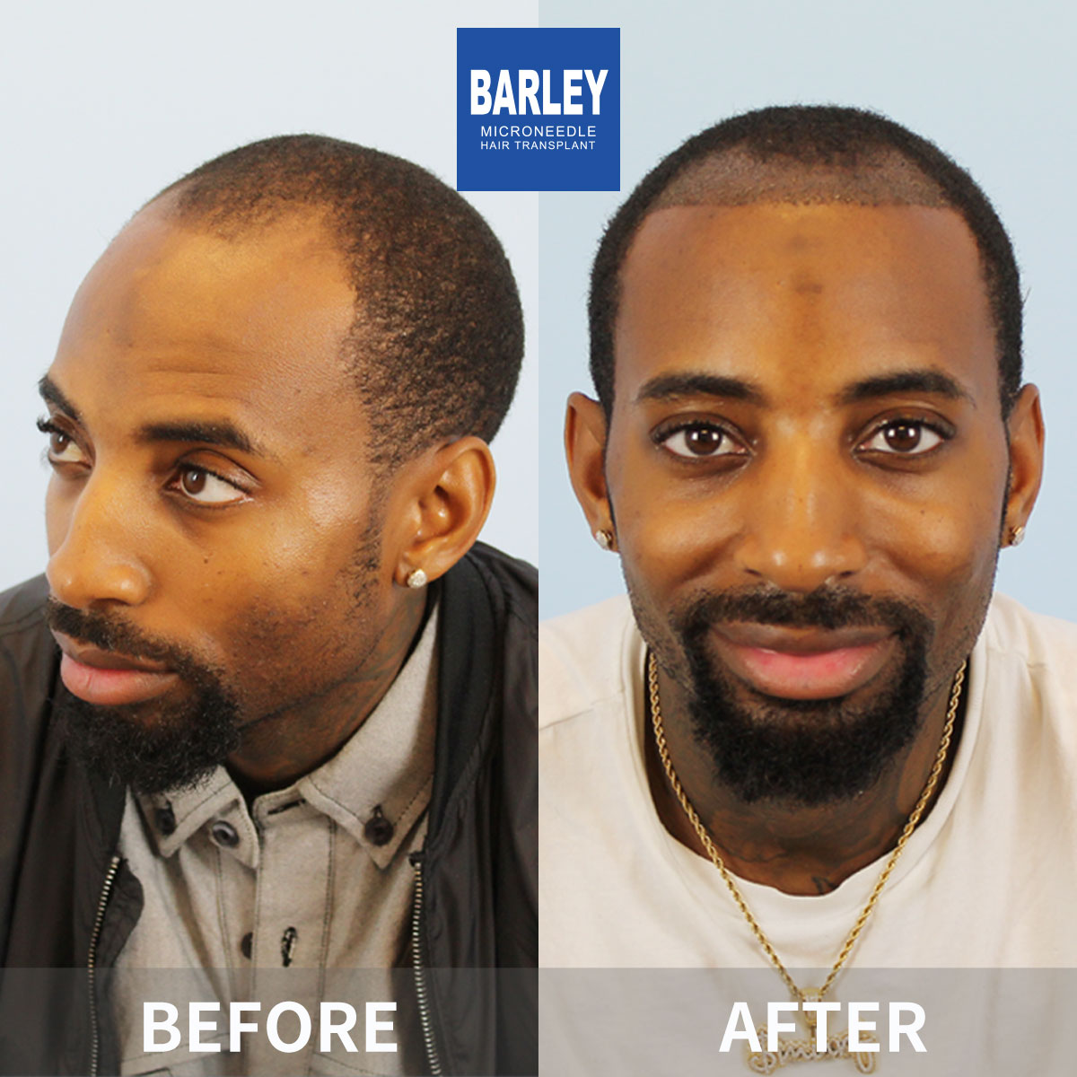 Lowered Hairline