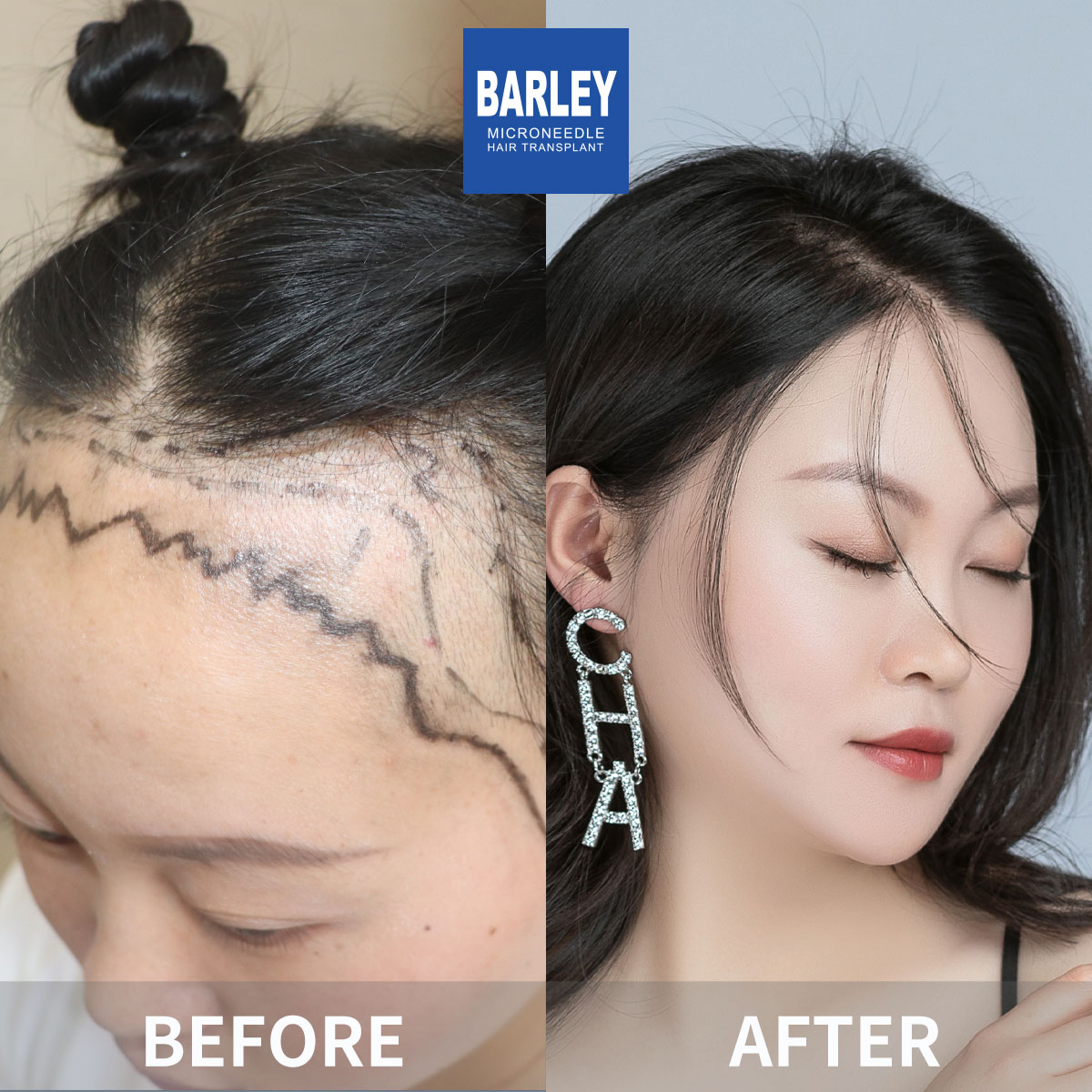 Female hair transplant - before and after