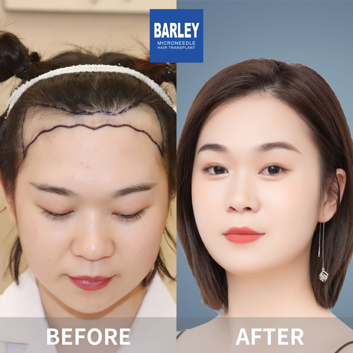 Female hair thickening results