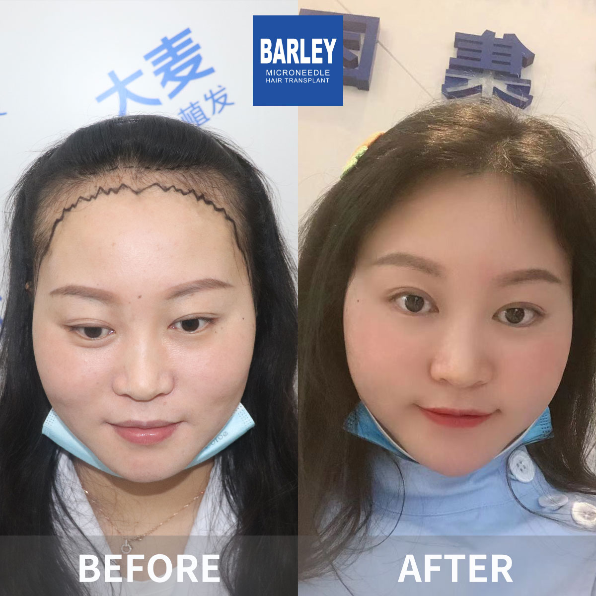 Female hair restoration results